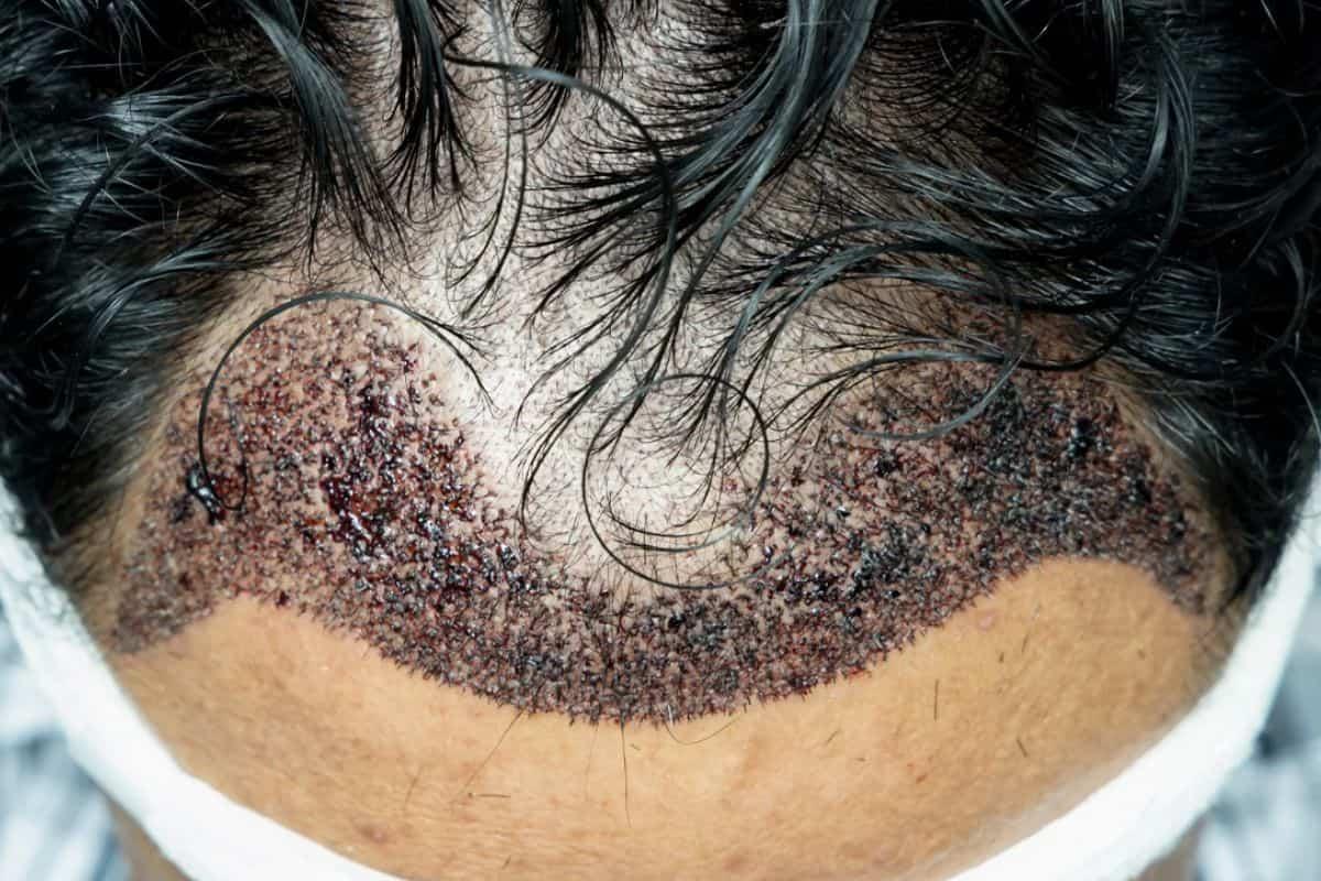 Bagaimana Hukum Tanam Rambut dalam Islam: Apakah Boleh?