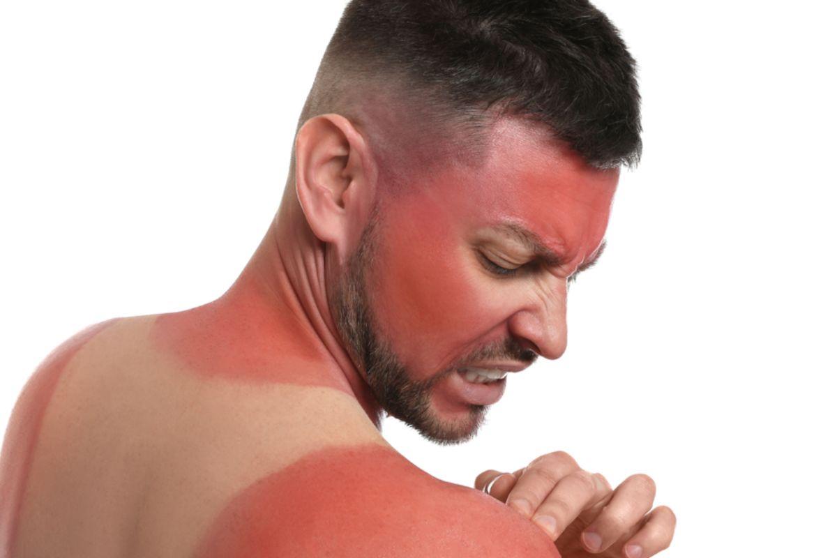 Mengenal Sunburn: Penyebab, Cara Mengatasi & Rekomendasi Produk Sunscreen