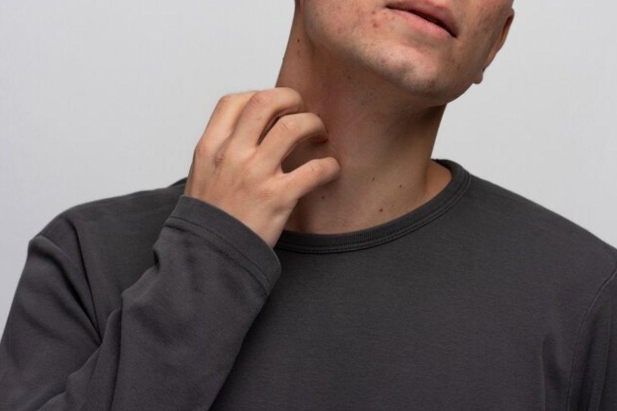 Biang Keringat: Penyebab, Gejala, dan Cara Mengatasinya